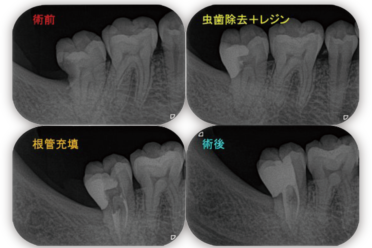 レントゲン